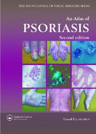 An Atlas Of Psoriasis