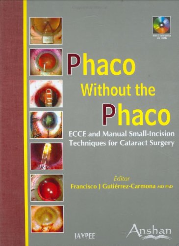 Phaco Without the Phaco: Ecce And Manual Small Incision Techniques for Cataract Surgery